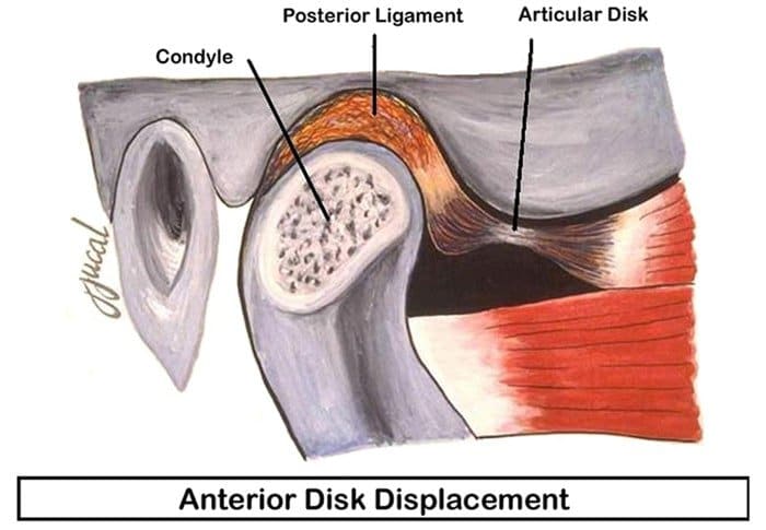 Illustration showing an anterior disk displacement