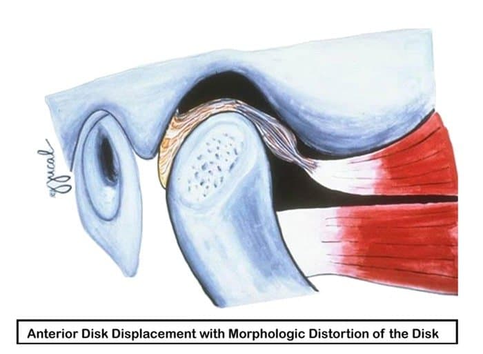 Illustration showing an anterior disk displacement with morphologic distortion of the disk