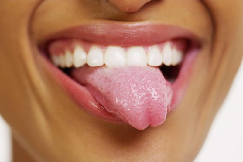 Another Symptom of A Bad Bite, A Scalloped Tongue