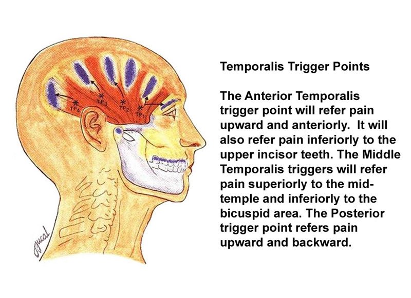 migraines01 Temporalis trigger points for migraine headaches