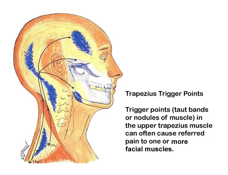migraines02 trapezius trigger points that can cause headaches