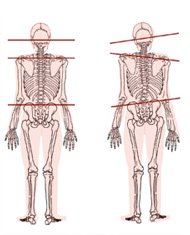 Diagram showing an imbalanced skeletal system
